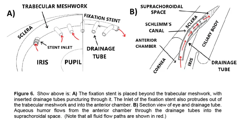 Fixation Stent with Inserted Drainage Tubes